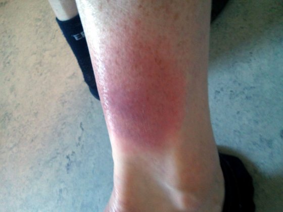 Borrelia?