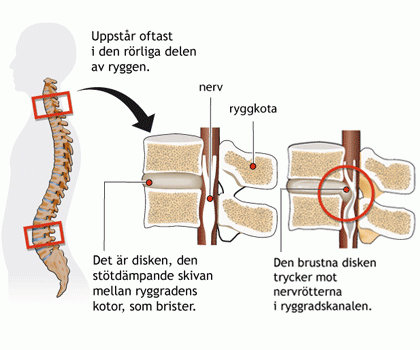 Ryggproblem